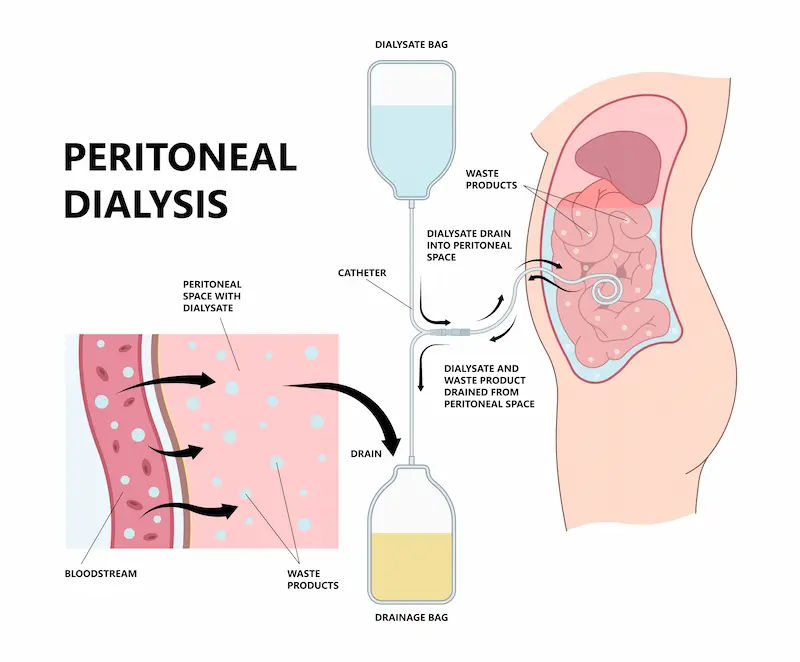 Peritoneal Disorders Overview and Treatment